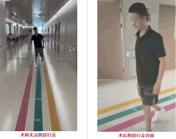 间充质干细胞治疗脊髓损伤更有效?还是神经干细胞? 3 20250924194718 68d3da466c612