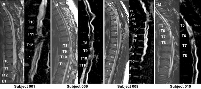 间充质干细胞治疗脊髓损伤更有效?还是神经干细胞? 5 MRI颈胸T2矢状图和AvDC矢状图