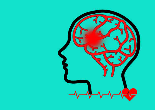 哪些中风患者适合干细胞治疗？专家公布了5大评估标准