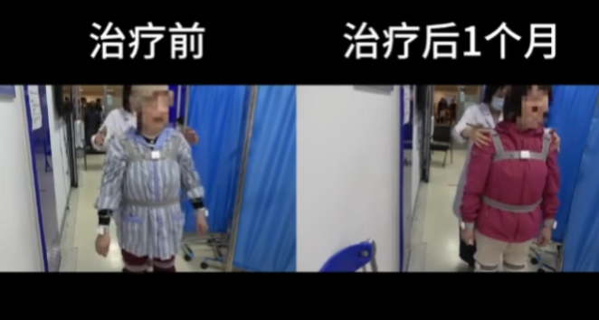 3位帕金森病患者亲述:参与帕金森病干细胞临床试验的完整经历与效果! 6 20250924200112 68d3dd883c2aa