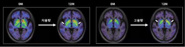 干细胞治疗帕金森病是骗局吗?2025最新进展与避坑指南 3 低剂量和高剂量TED-A9植入一年后的脑成像。