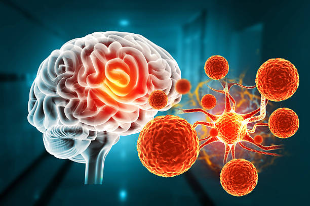 干细胞治疗帕金森病取得新进展！II期临床证实：3次输注，安全且运动功能得到改善