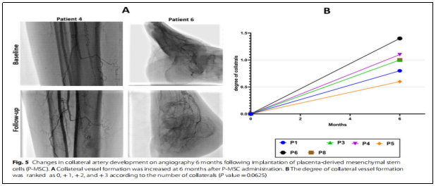 干细胞治疗严重肢体缺血:I期临床试验报告安全性与可行性 | 患者希望 5 20250924200138 68d3dda2322d9