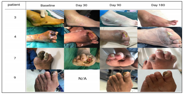 干细胞治疗严重肢体缺血:I期临床试验报告安全性与可行性 | 患者希望 7 20250924200138 68d3dda24b592