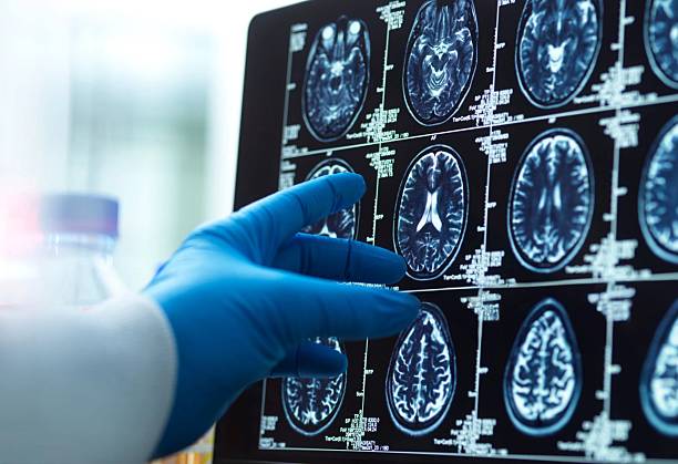 神经干细胞移植十大常见问题解答：从原理到术后护理全知道