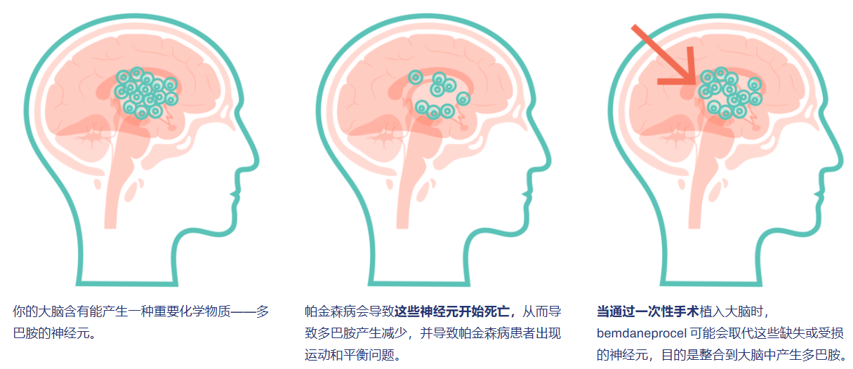 拜耳公司帕金森病干细胞新药bemdaneprocel进入关键性3期临床,完成首例患者给药 5 wechat 2025 09 24 113931 977