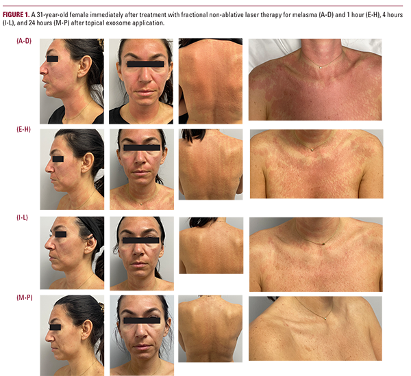 干细胞外泌体是智商税吗?理性分析其科学依据与真实效果 3 患者1治疗前后