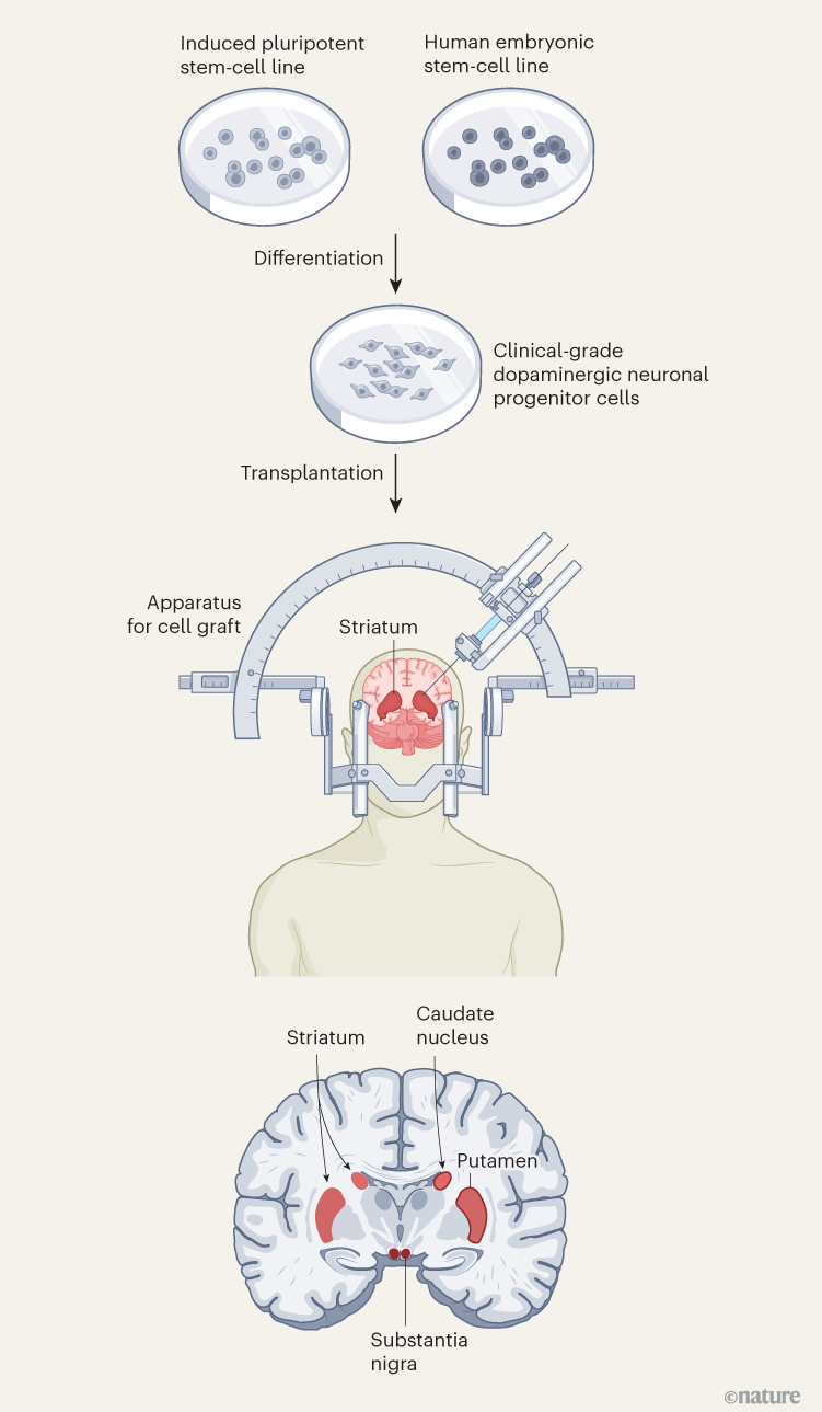 治疗帕金森病的方法有哪些：盘点最有希望的新兴疗法与研究前沿