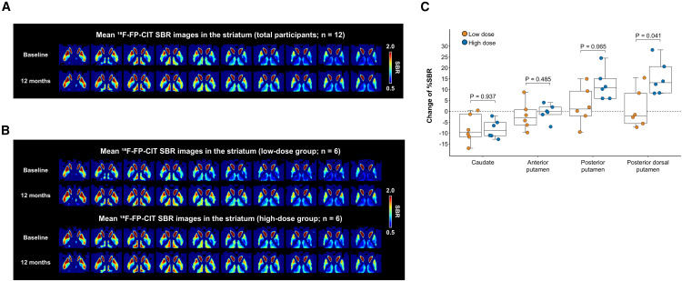 韩国胚胎干细胞治疗帕金森病新突破,12个月后运动症状显著改善,且高剂量疗效更佳 10 图4:基线和A9-DPC移植后12个月的18F-FP-CITSBR