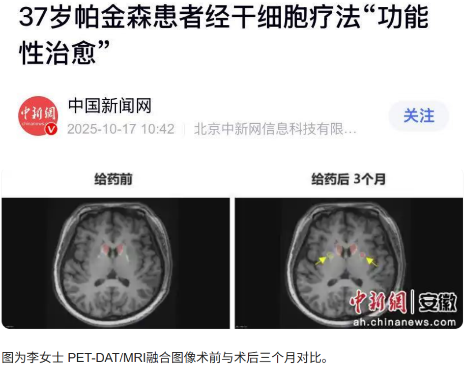 干细胞移植治疗帕金森病获突破:37岁患者移植3个月后实现“功能性治愈” 12 微信图片 2025 10 20 153950 831