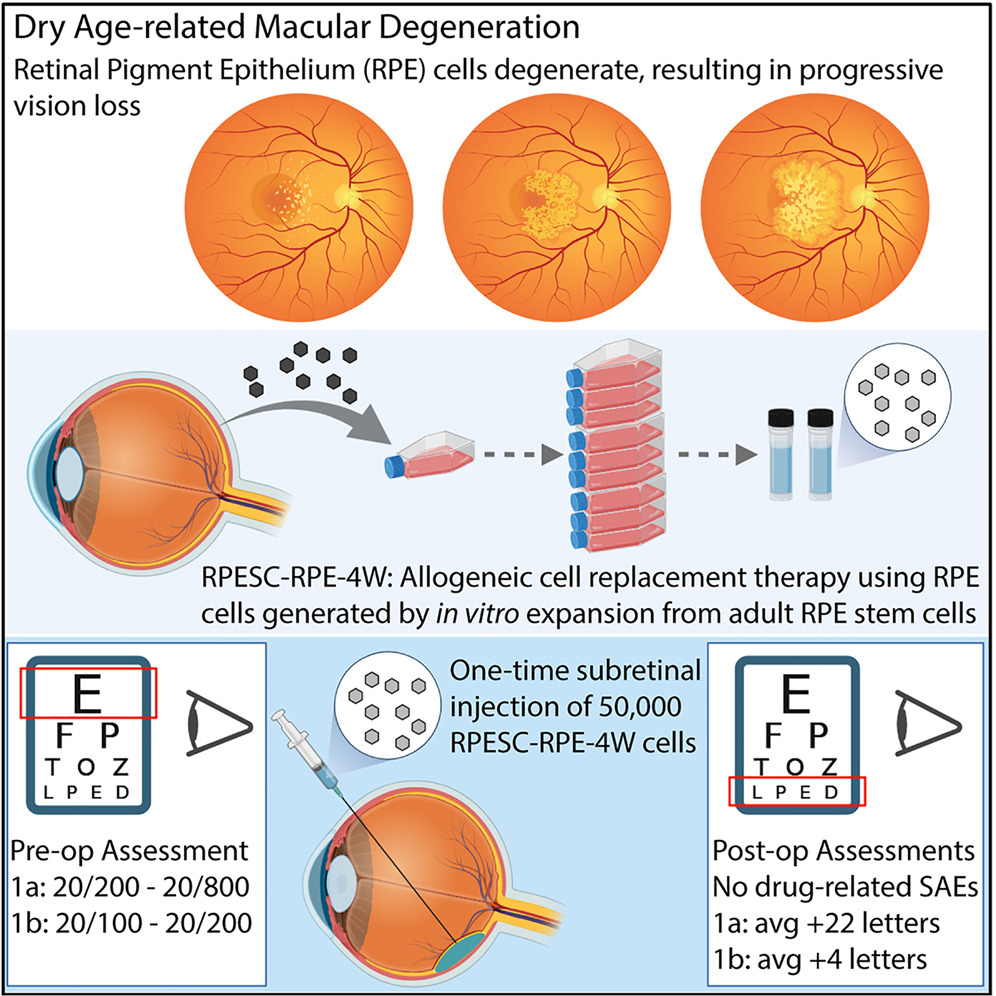 RPESC-RPE细胞治疗干性AMD的早期临床结果：安全性良好并显现视力改善信号