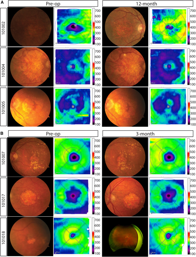 RPESC-RPE细胞治疗干性AMD的早期临床结果:安全性良好并显现视力改善信号 9 1 s2.0 S1934590925003042 gr4