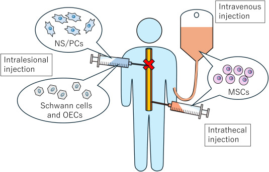 最新综述!2025年干细胞治疗脊髓损伤的临床研究进展 4 1 s2.0 S2772529425000268 gr1