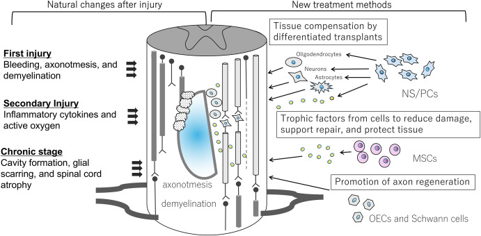 最新综述!2025年干细胞治疗脊髓损伤的临床研究进展 5 图 2.脊髓损伤 (SCI) 的进展以及不同细胞类型细胞移植预期治疗效果的潜在机制。缩写:神经干/祖细胞 (NS/PCs);嗅鞘细胞 (OECs)。