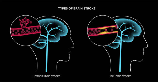 从瘫痪到复健!神经干细胞疗法5大机制如何促进中风后的大脑修复? 2 从瘫痪到复健!神经干细胞疗法5大机制如何促进中风后的大脑修复?