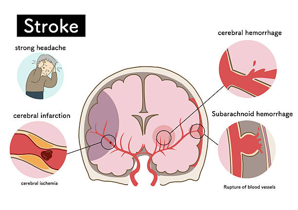 鞘内与静脉注射干细胞治疗中风后遗症:均能改善患者神经功能恢复和生活质量,但静脉注射安全性更优! 2 鞘内与静脉注射干细胞治疗中风后遗症:均能改善患者神经功能恢复和生活质量,但静脉注射安全性更优!