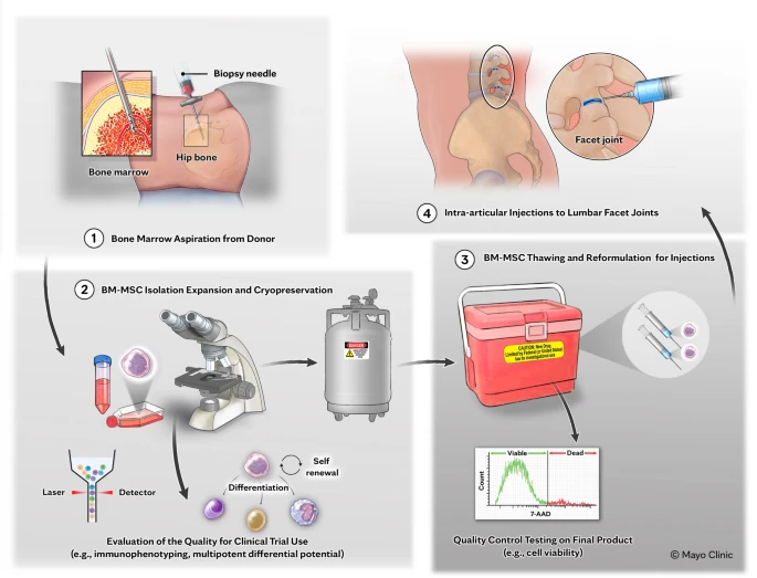 干细胞治疗椎间盘突出:梅奥I期试验证实直接靶向注射安全有效,随访2年显著改善结构与功能 3 图1:骨髓间充质干细胞的生产、制备和管理