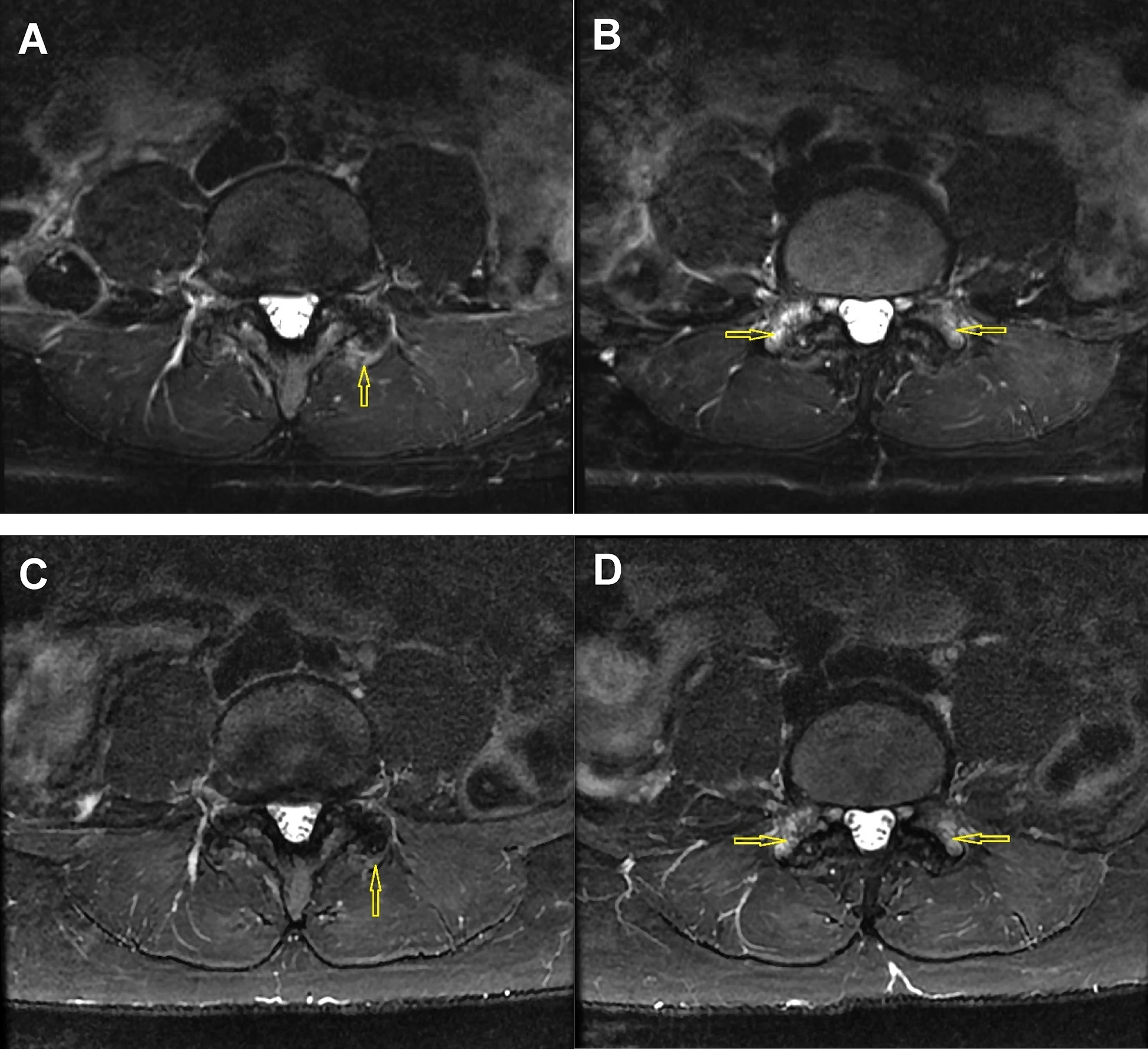 干细胞治疗椎间盘突出:梅奥I期试验证实直接靶向注射安全有效,随访2年显著改善结构与功能 6 图2:图A和B为骨髓间充质干细胞(BM-MSC)注射前,图C和D为注射后24个月的L4-L5小关节脂肪抑制T2加权轴位Dixon图像。治疗前图像A显示左侧小关节周长50%以上出现水肿;图像B显示双侧L5上关节突广泛反应性骨髓水肿(3级滑膜炎)。治疗后24个月,图像C显示关节囊水肿明显减轻,关节周长50%以下;图像D显示双侧骨髓水肿略有减轻(2级滑膜炎)。