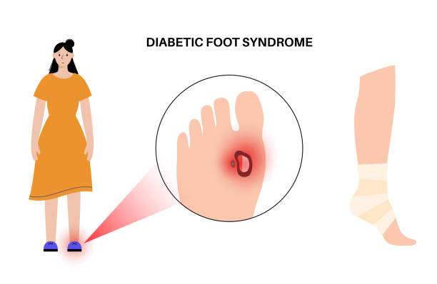 人脐带间充质干细胞治疗糖尿病足溃疡:10名患者均在4.2周内实现了溃疡完全愈合! 6 人脐带间充质干细胞治疗糖尿病足溃疡:10名患者均在4.2周内实现了溃疡完全愈合!