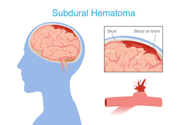 神经干细胞移植治疗脑出血的系统评价:NSC来源、输送途径、治疗机制和早期临床试验 2 神经干细胞移植治疗脑出血的系统评价:NSC来源、输送途径、治疗机制和早期临床试验