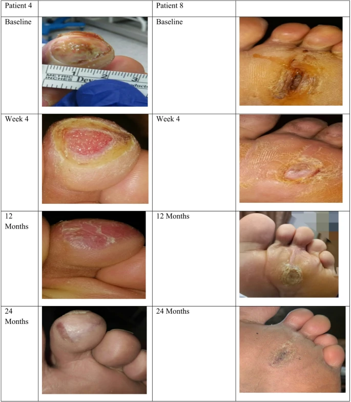 人脐带间充质干细胞治疗糖尿病足溃疡:10名患者均在4.2周内实现了溃疡完全愈合! 12 微信图片 2025 12 02 163132 252