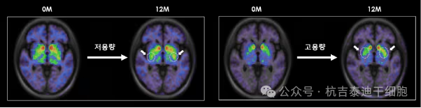 2025年(1-12月)干细胞治疗帕金森病的临床转化新趋势,让神经再生从梦想照进现实 6 微信图片 2025 12 12 161156 005