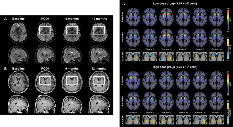 图6：代表性脑部MRI图像以及A9-DPC移植后18F -FP-CIT摄取量的个体水平变化