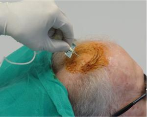 干细胞注射到大脑过程。