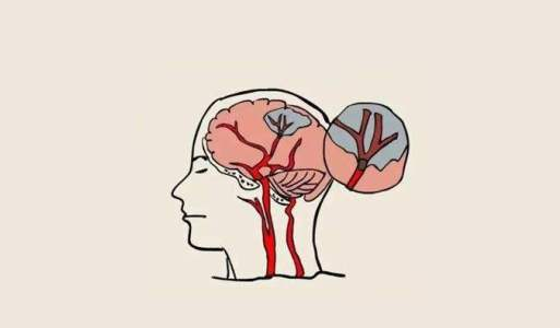 中风后的脑损伤，真的能被干细胞疗法逆转吗？