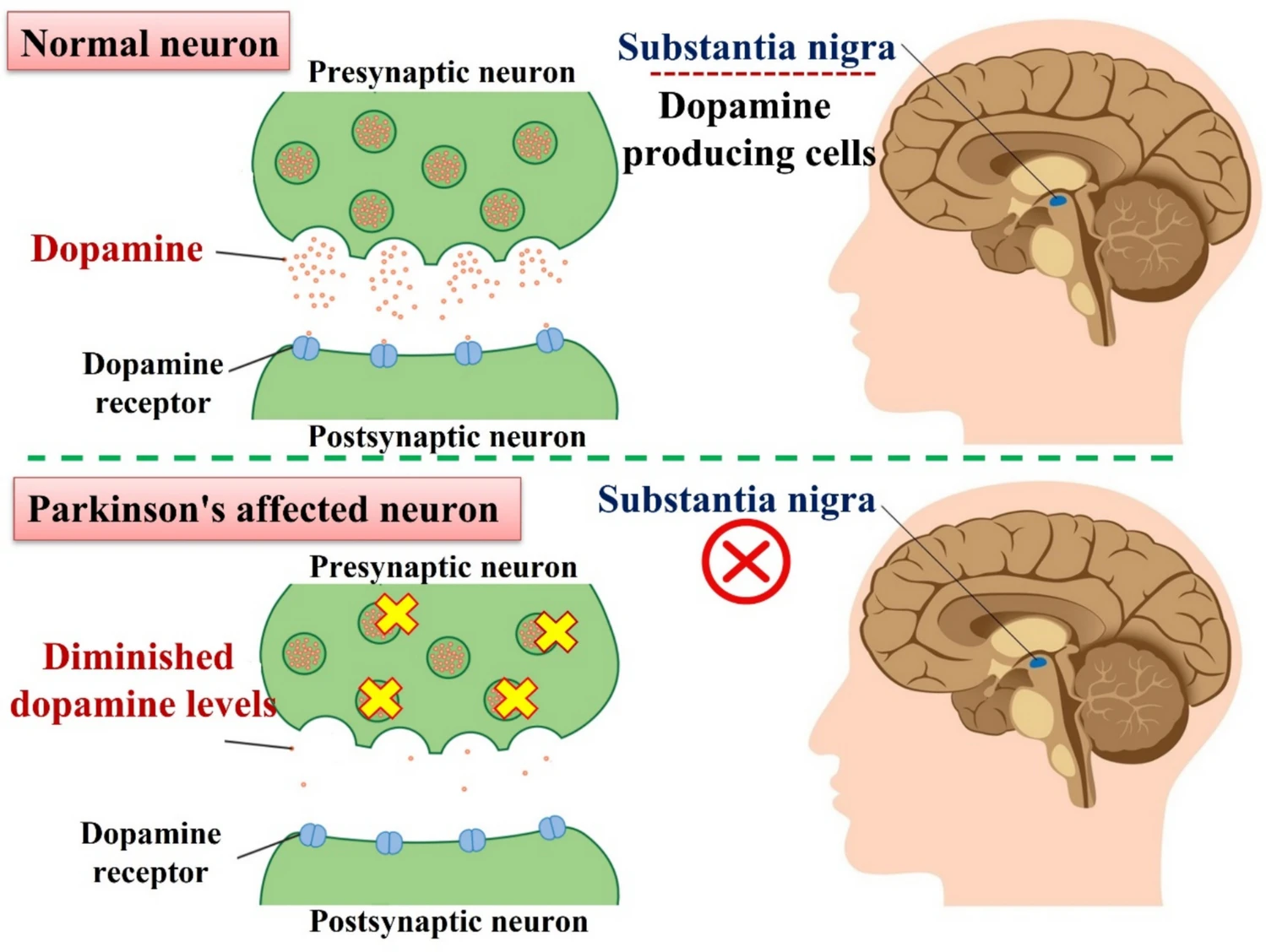 图3:帕金森病(PD)是中脑黑质多巴胺(DA)神经元退化的直接结果。 DA神经元产生多巴胺,这是一种负责与大脑其他神经元进行通讯的化学信使。这些神经元延伸至基底神经节(纹状体区域),该区域与运动控制和功能密切相关。因此,纹状体中多巴胺水平的降低会导致帕金森病患者常见的运动和非运动症状。 微信图片 2026 01 06 140233 130